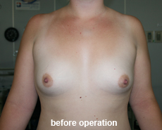 plastic-surgery-breast-augmentation
